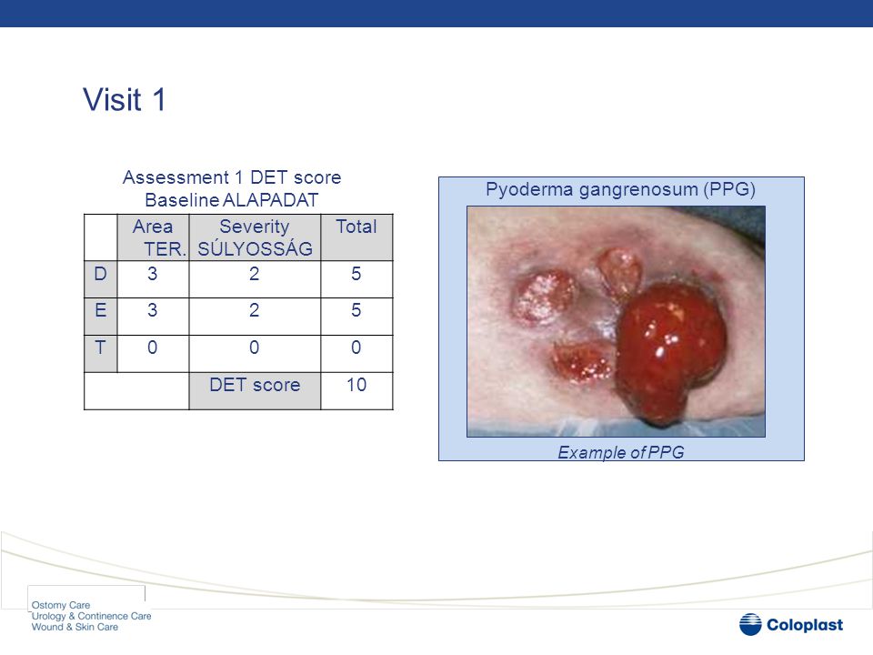 Visit 1 Pyoderma gangrenosum (PPG) Example of PPG Area TER.