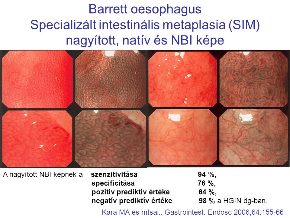 Barrett oesophagus Specializált intestinális metaplasia (SIM) nagyított, natív és NBI képe Kara MA és mtsai.: Gastrointest.