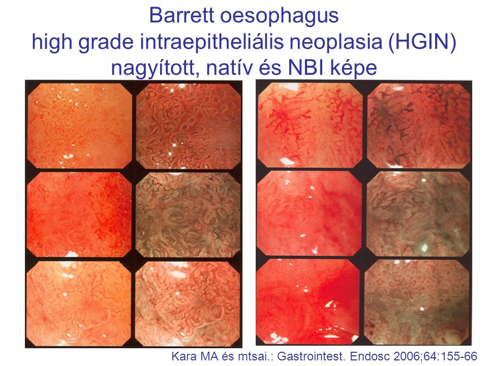 Barrett oesophagus high grade intraepitheliális neoplasia (HGIN) nagyított, natív és NBI képe Kara MA és mtsai.: Gastrointest.