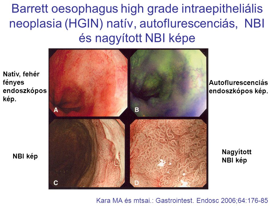 Barrett oesophagus high grade intraepitheliális neoplasia (HGIN) natív, autoflurescenciás, NBI és nagyított NBI képe Kara MA és mtsai.: Gastrointest.