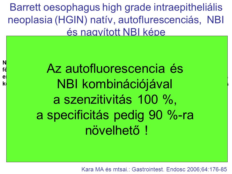 Barrett oesophagus high grade intraepitheliális neoplasia (HGIN) natív, autoflurescenciás, NBI és nagyított NBI képe Kara MA és mtsai.: Gastrointest.