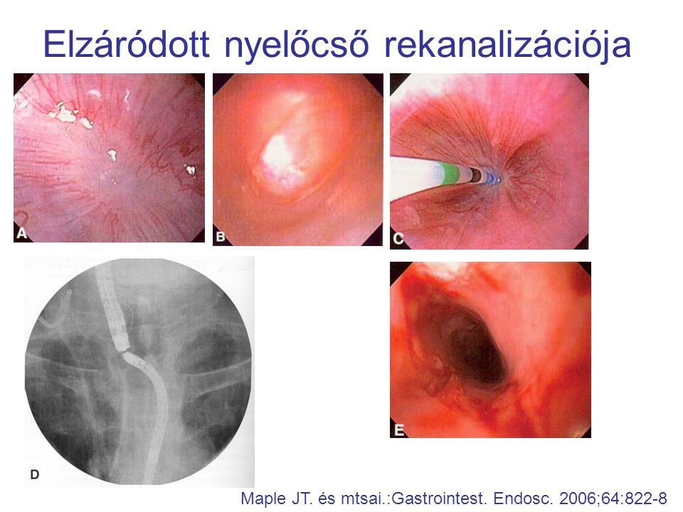 Elzáródott nyelőcső rekanalizációja Maple JT. és mtsai.:Gastrointest. Endosc. 2006;64:822-8