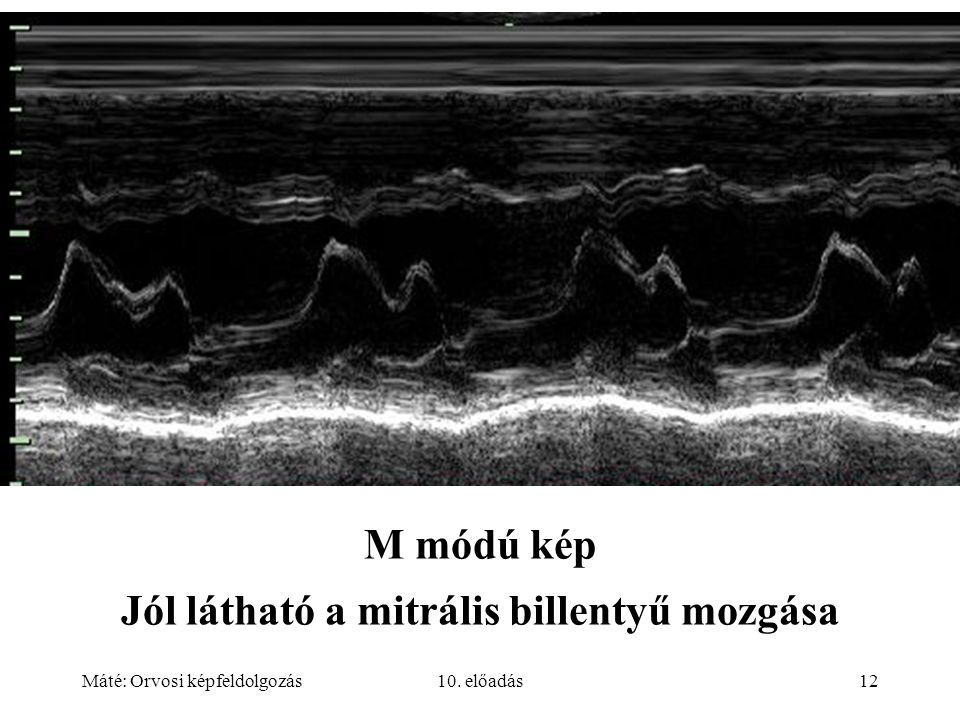 Máté: Orvosi képfeldolgozás10. előadás12 M módú kép Jól látható a mitrális billentyű mozgása