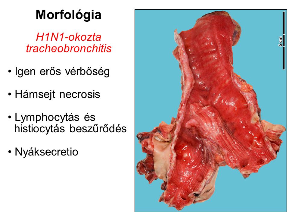 Morfológia H1N1-okozta tracheobronchitis Igen erős vérbőség Hámsejt necrosis Lymphocytás és histiocytás beszűrődés Nyáksecretio