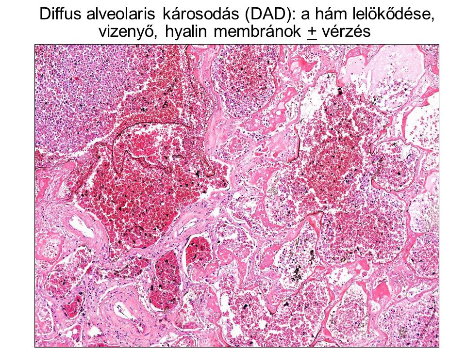 Diffus alveolaris károsodás (DAD): a hám lelökődése, vizenyő, hyalin membránok + vérzés