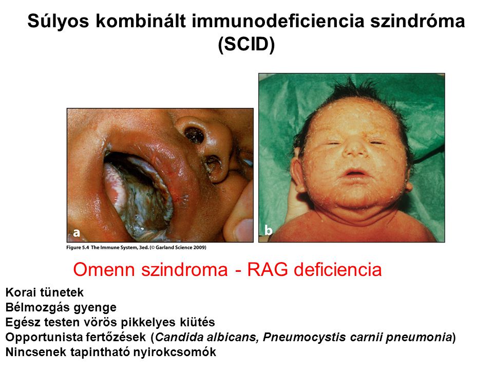 Súlyos kombinált immunodeficiencia szindróma (SCID) Korai tünetek Bélmozgás gyenge Egész testen vörös pikkelyes kiütés Opportunista fertőzések (Candida albicans, Pneumocystis carnii pneumonia) Nincsenek tapintható nyirokcsomók Omenn szindroma - RAG deficiencia