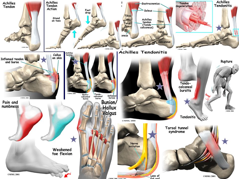a duzzadt lábízületek kezelése artrózis artritisz kenőcskezelés