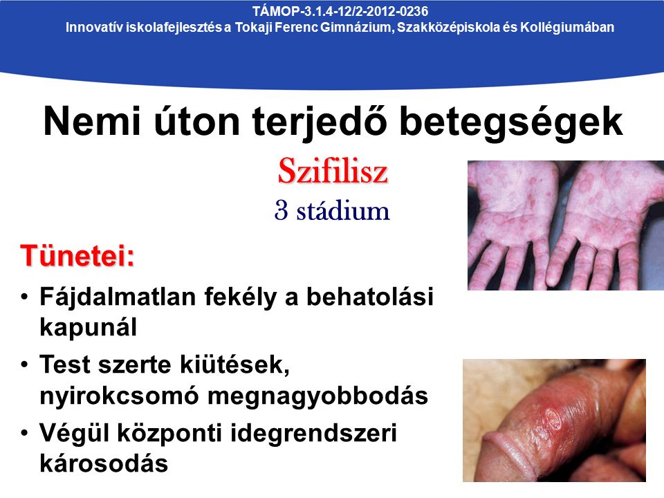 szifilisz prosztatitis)