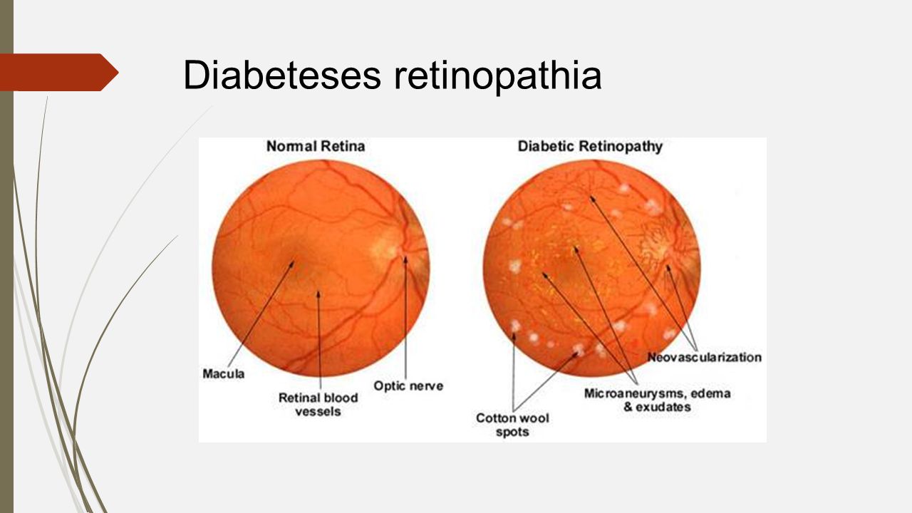 retinopathia jelentese)