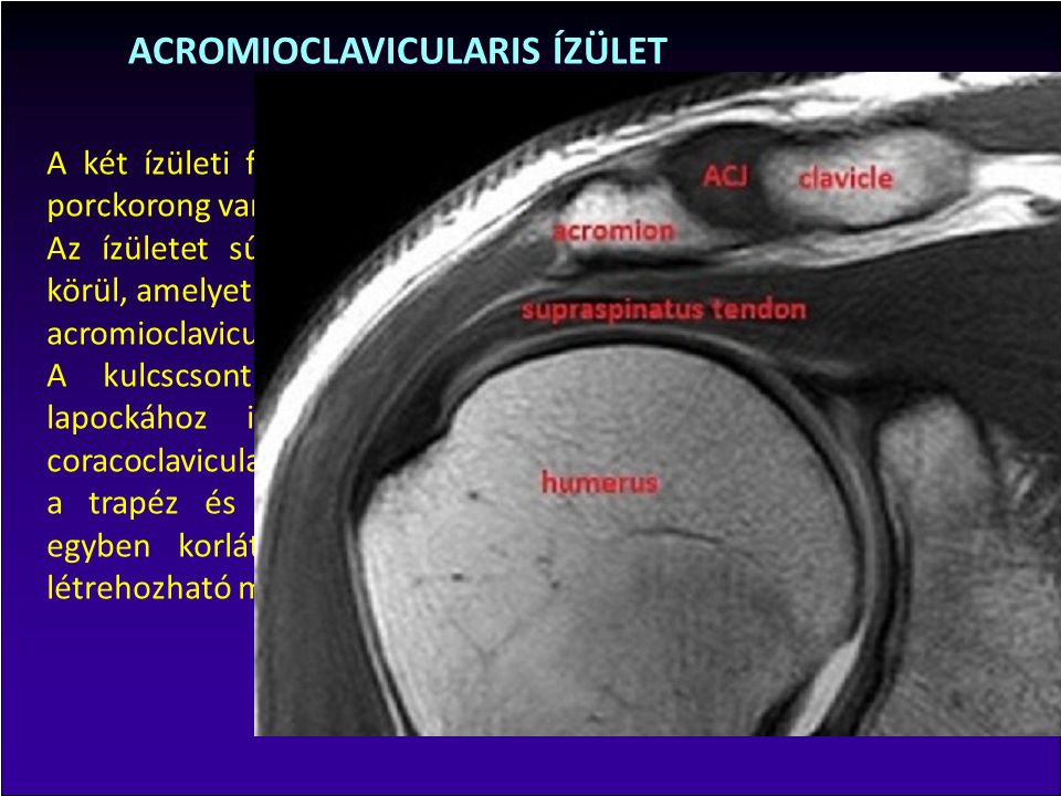 1 fokos acromioclavicularis ízület artrózisa