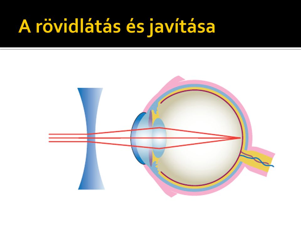 Látást javító eszközök típusú szemüvegek, Látásjavító eszközök - Novák Optika