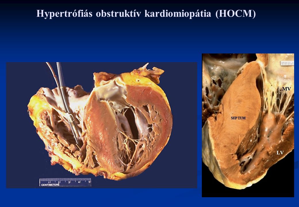 Hypertrófiás obstruktív kardiomiopátia (HOCM)