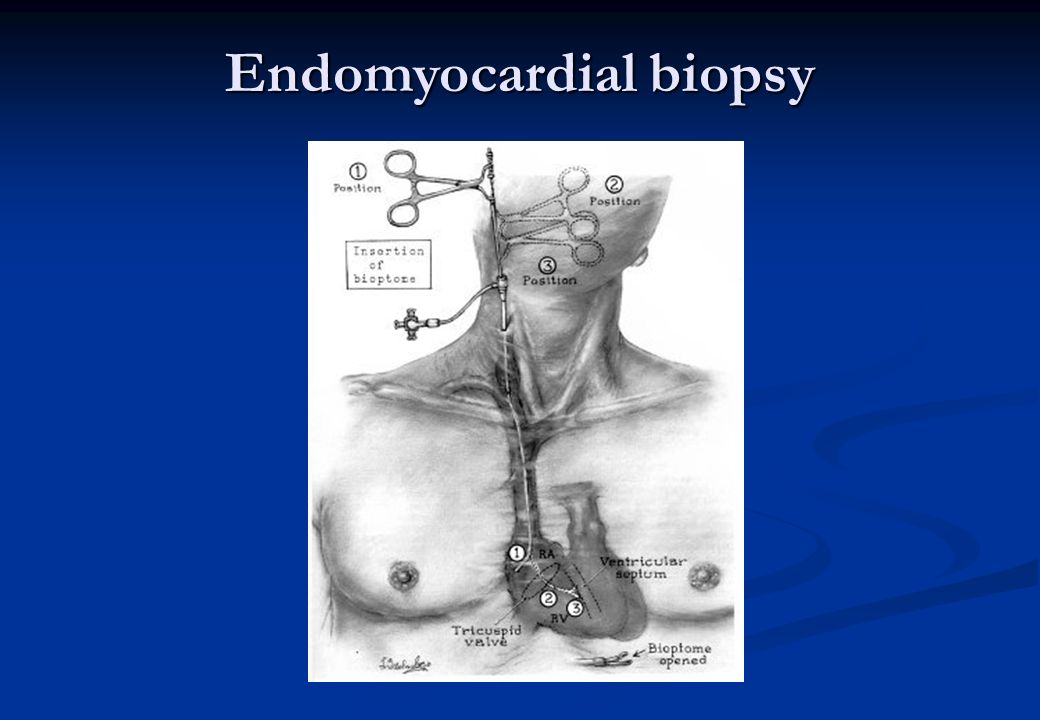 Endomyocardial biopsy