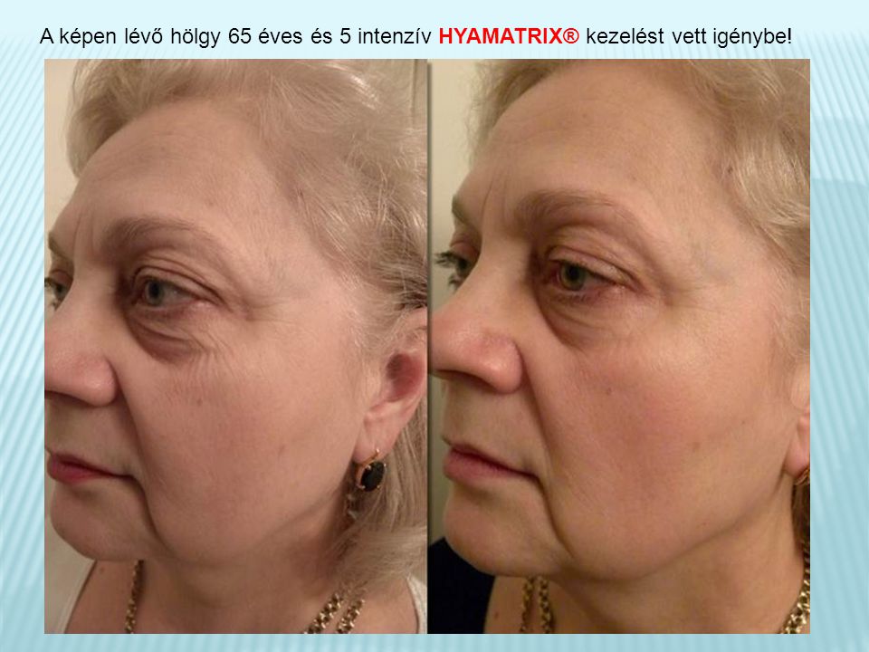 A képen lévő hölgy 65 éves és 5 intenzív HYAMATRIX® kezelést vett igénybe!