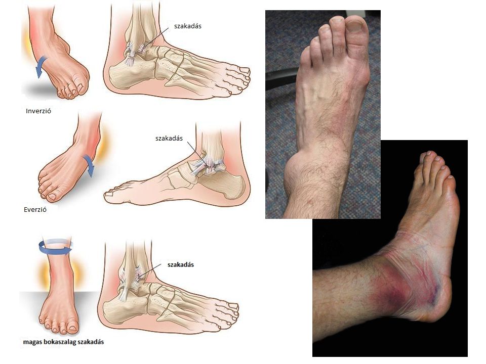 Bokaszalag sérülés: a bokaszalag szakadás - Fájdalomközpont