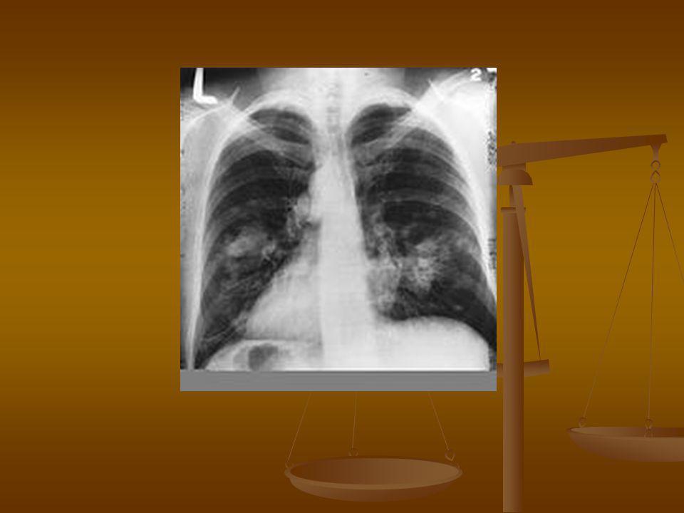 A 4. stádiumú tüdőrák és a tünetek a halál előtt - Cirrózis