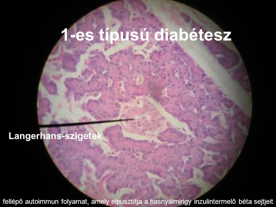 1-es típusú diabétesz Langerhans-szigetek fellépő autoimmun folyamat, amely elpusztítja a hasnyálmirigy inzulintermelő béta sejtjeit