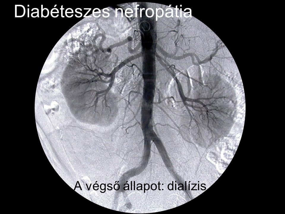 Diabéteszes nefropátia A végső állapot: dialízis