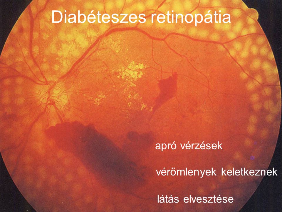 Diabéteszes retinopátia apró vérzések vérömlenyek keletkeznek látás elvesztése