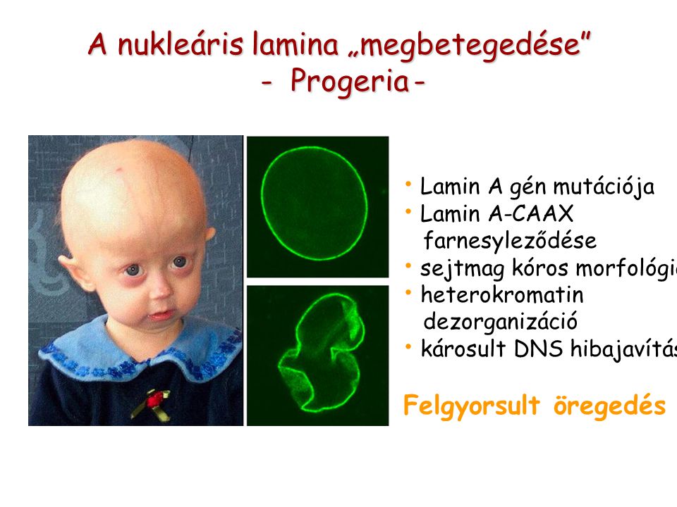 A nukleáris lamina „megbetegedése - Progeria- - Progeria - Lamin A gén mutációja Lamin A-CAAX farnesyleződése sejtmag kóros morfológia heterokromatin dezorganizáció károsult DNS hibajavítás Felgyorsult öregedés