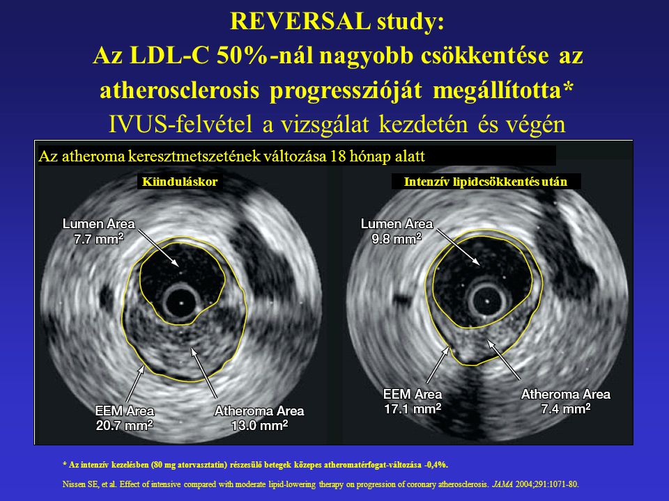 REVERSAL study: Az LDL-C 50%-nál nagyobb csökkentése az atherosclerosis progresszióját megállította* IVUS-felvétel a vizsgálat kezdetén és végén * Az intenzív kezelésben (80 mg atorvasztatin) részesülő betegek közepes atheromatérfogat-változása -0,4%.