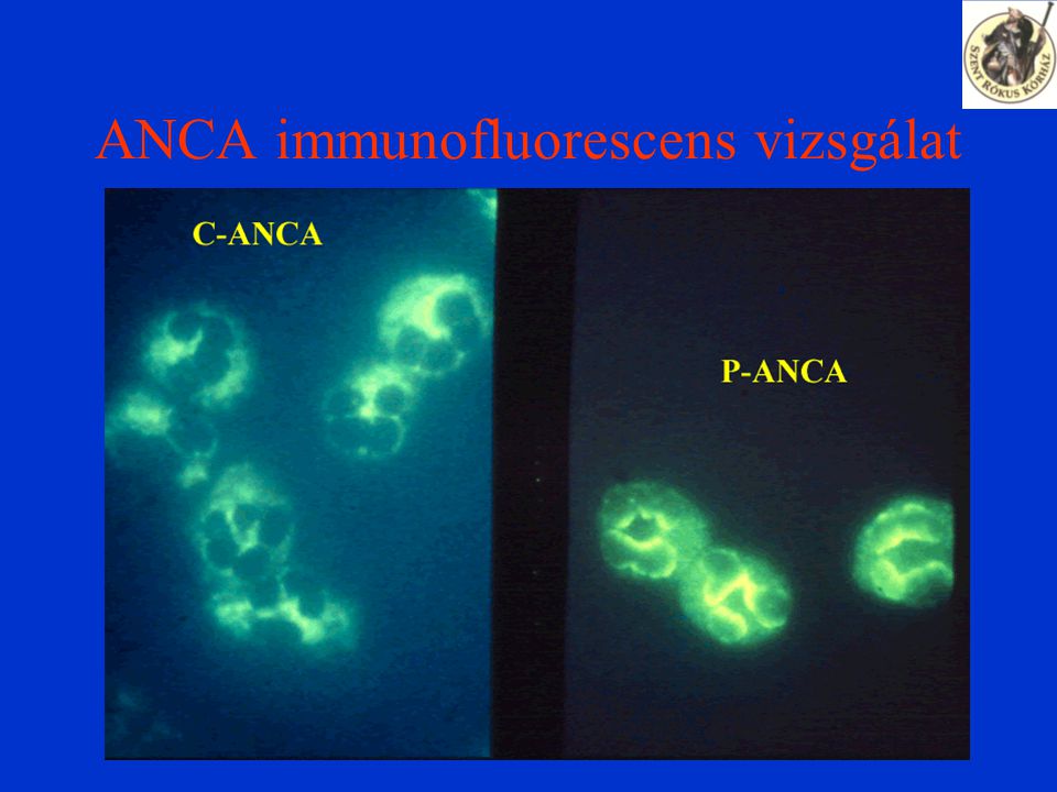 ANCA immunofluorescens vizsgálat