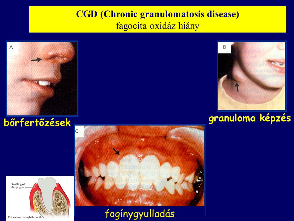 CGD (Chronic granulomatosis disease) fagocita oxidáz hiány fogínygyulladás bőrfertőzések granuloma képzés