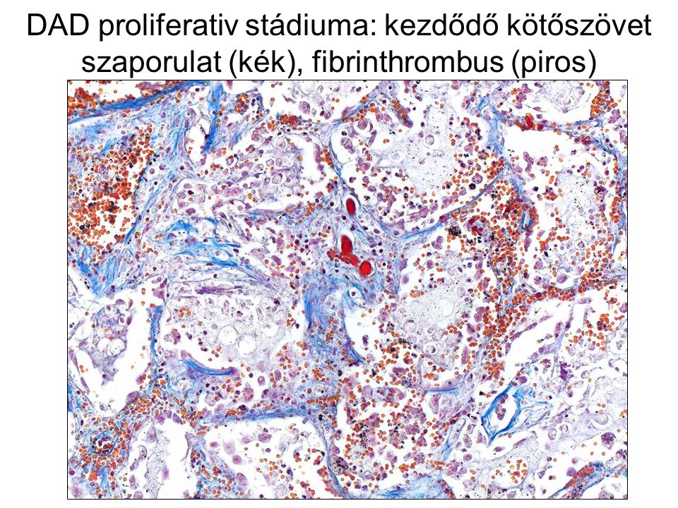 DAD proliferativ stádiuma: kezdődő kötőszövet szaporulat (kék), fibrinthrombus (piros)