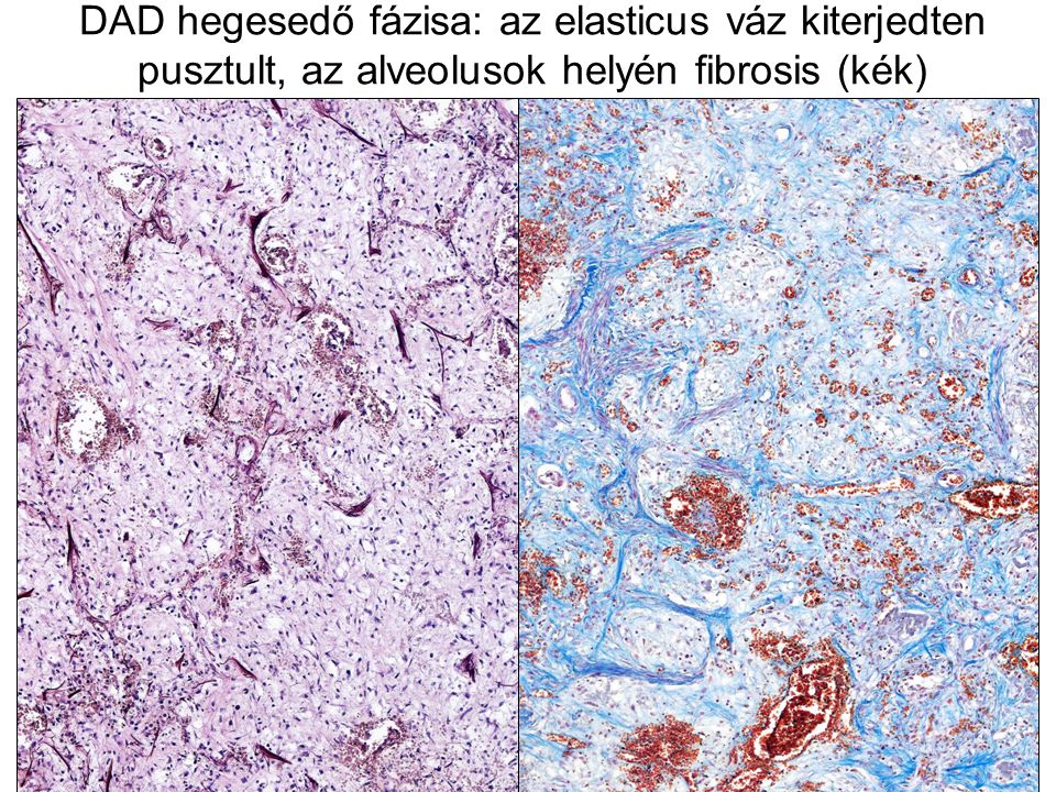 DAD hegesedő fázisa: az elasticus váz kiterjedten pusztult, az alveolusok helyén fibrosis (kék)