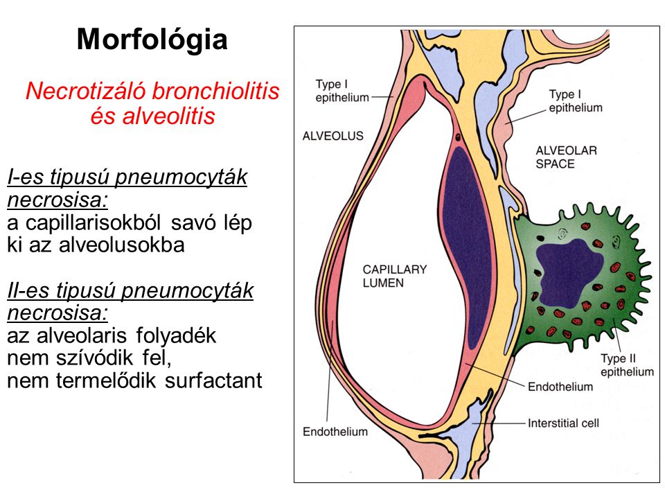 Morfológia Necrotizáló bronchiolitis és alveolitis I-es tipusú pneumocyták necrosisa: a capillarisokból savó lép ki az alveolusokba II-es tipusú pneumocyták necrosisa: az alveolaris folyadék nem szívódik fel, nem termelődik surfactant