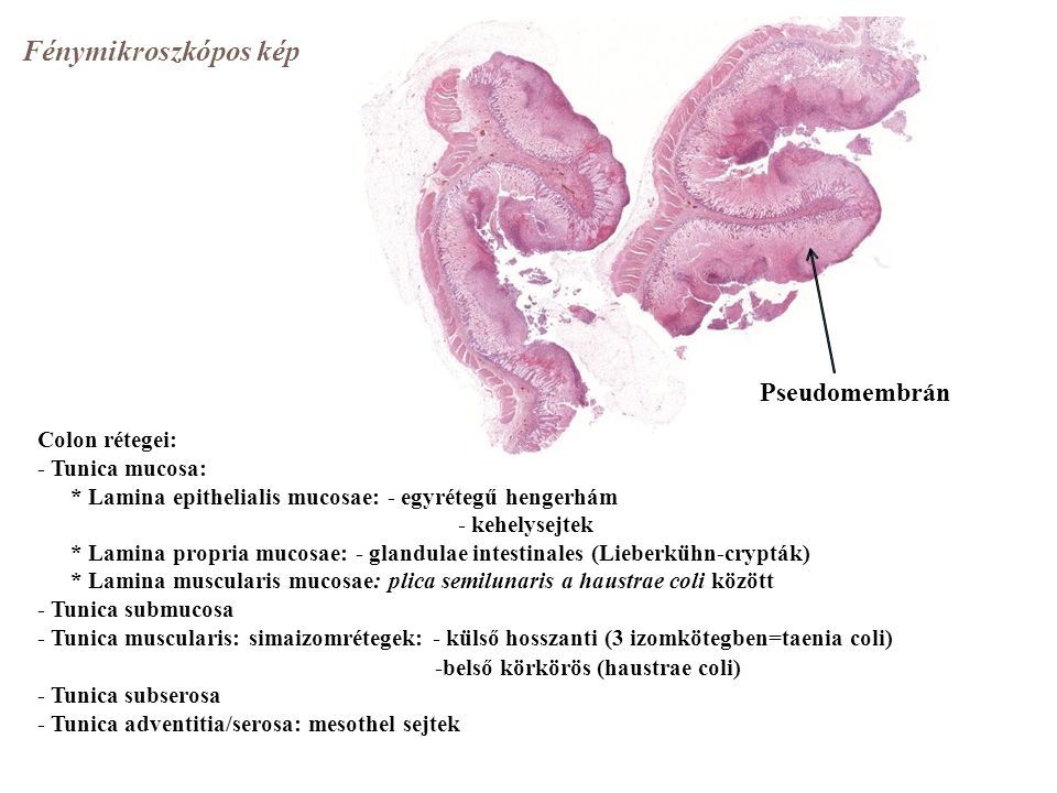 Fénymikroszkópos kép Pseudomembrán Colon rétegei: - Tunica mucosa: * Lamina epithelialis mucosae: - egyrétegű hengerhám - kehelysejtek * Lamina propria mucosae: - glandulae intestinales (Lieberkühn-crypták) * Lamina muscularis mucosae: plica semilunaris a haustrae coli között - Tunica submucosa - Tunica muscularis: simaizomrétegek: - külső hosszanti (3 izomkötegben=taenia coli) -belső körkörös (haustrae coli) - Tunica subserosa - Tunica adventitia/serosa: mesothel sejtek