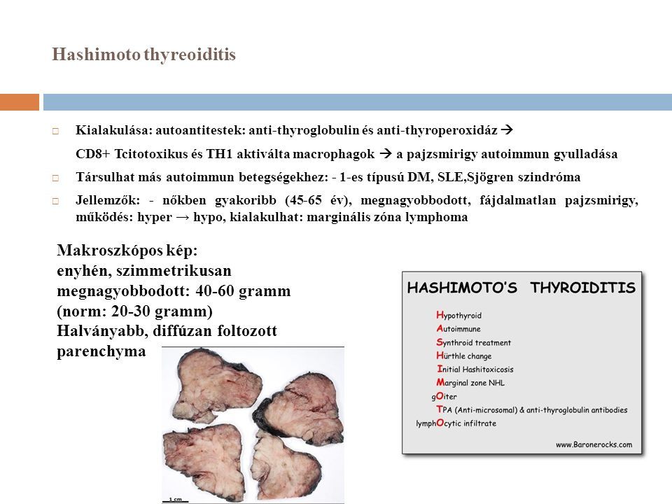 Hashimoto thyreoiditis  Kialakulása: autoantitestek: anti-thyroglobulin és anti-thyroperoxidáz  CD8+ Tcitotoxikus és TH1 aktiválta macrophagok  a pajzsmirigy autoimmun gyulladása  Társulhat más autoimmun betegségekhez: - 1-es típusú DM, SLE,Sjögren szindróma  Jellemzők: - nőkben gyakoribb (45-65 év), megnagyobbodott, fájdalmatlan pajzsmirigy, működés: hyper → hypo, kialakulhat: marginális zóna lymphoma Makroszkópos kép: enyhén, szimmetrikusan megnagyobbodott: gramm (norm: gramm) Halványabb, diffúzan foltozott parenchyma
