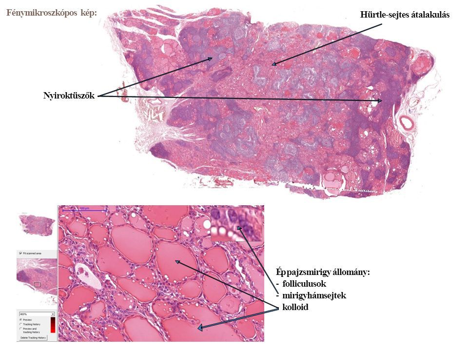 Fénymikroszkópos kép: Ép pajzsmirigy állomány: -folliculusok -mirigyhámsejtek -kolloid Hürtle-sejtes átalakulás Nyiroktüszők