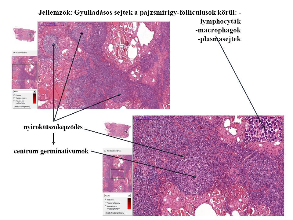 Jellemzők: Gyulladásos sejtek a pajzsmirigy-folliculusok körül: - lymphocyták -macrophagok -plasmasejtek nyiroktüszőképződés centrum germinativumok