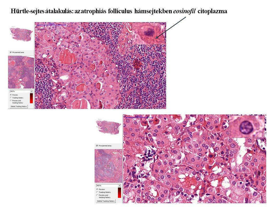 Hürtle-sejtes átalakulás: az atrophiás folliculus hámsejtekben eosinofil citoplazma