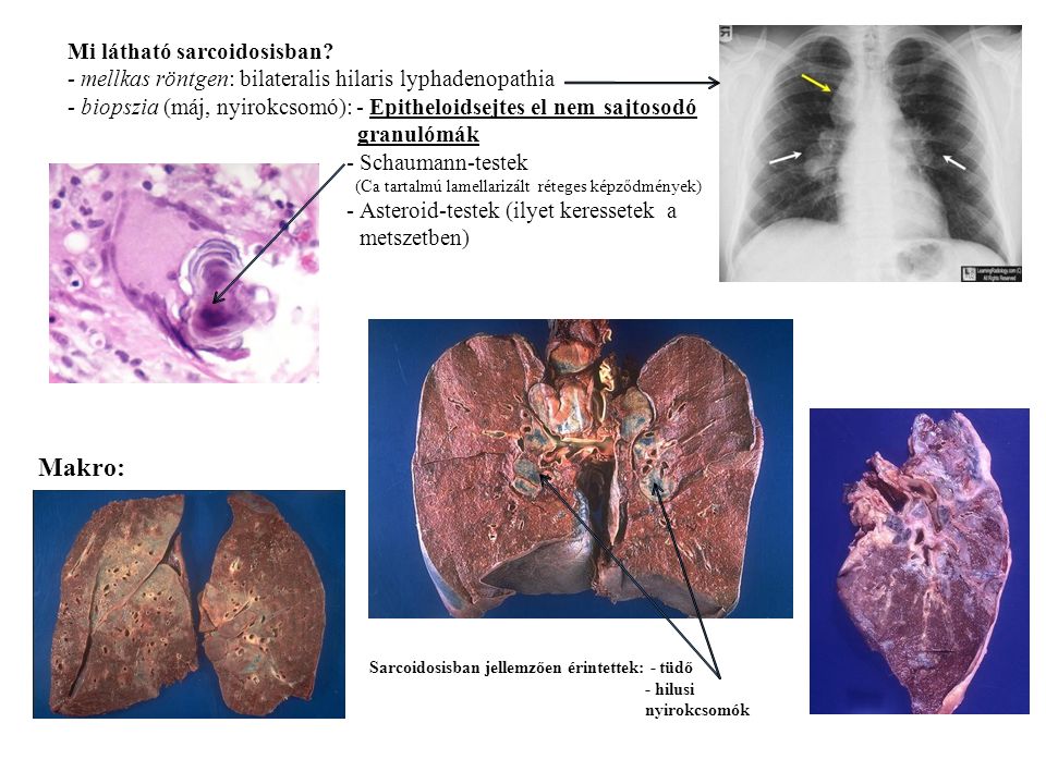 Sarcoidosisban jellemzően érintettek: - tüdő - hilusi nyirokcsomók Mi látható sarcoidosisban.