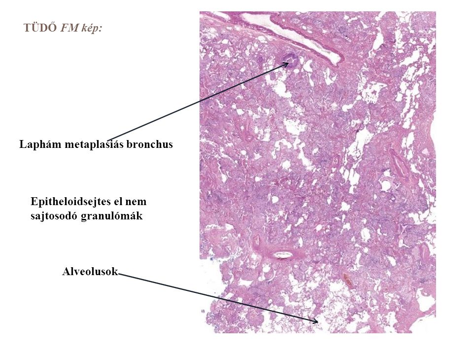 Laphám metaplasiás bronchus Alveolusok Epitheloidsejtes el nem sajtosodó granulómák TÜDŐ FM kép:
