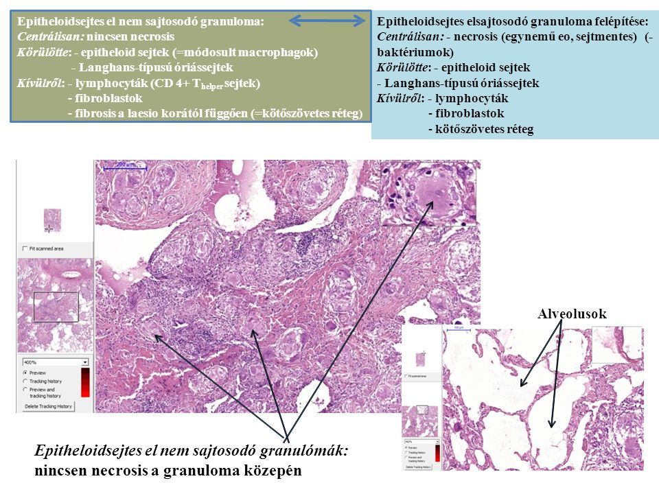 Alveolusok Epitheloidsejtes el nem sajtosodó granulómák: nincsen necrosis a granuloma közepén Epitheloidsejtes elsajtosodó granuloma felépítése: Centrálisan: - necrosis (egynemű eo, sejtmentes) (- baktériumok) Körülötte: - epitheloid sejtek - Langhans-típusú óriássejtek Kívülről: - lymphocyták -fibroblastok -kötőszövetes réteg Epitheloidsejtes el nem sajtosodó granuloma: Centrálisan: nincsen necrosis Körülötte: - epitheloid sejtek (=módosult macrophagok) - Langhans-típusú óriássejtek Kívülről: - lymphocyták (CD 4+ T helper sejtek) -fibroblastok -fibrosis a laesio korától függően (=kötőszövetes réteg )