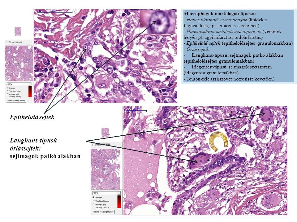 Epitheloid sejtek Langhans-típusú óriássejtek: sejtmagok patkó alakban Macrophagok morfológiai típusai: - Habos plazmájú macrophagok (lipideket fagocitálnak, pl: infarctus cerebriben) - Haemosiderin tartalmú macrophagok (vérzések helyén pl: agyi infarctus, tüdőinfarctus) - Epitheloid sejtek (epitheloidsejtes granulomákban) - Óriássejtek: - Langhans-típusú, sejtmagok patkó alakban (epitheloidsejtes granulomákban) -Idegentest-típusú, sejtmagok szétszórtan (idegentest granulomákban) - Touton-féle (zsírszövet necrosisát követően)