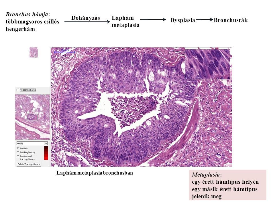 Laphám metaplasia bronchusban Bronchus hámja: többmagsoros csillós hengerhám Bronchusrák Metaplasia: egy érett hámtípus helyén egy másik érett hámtípus jelenik meg DohányzásLaphám metaplasia Dysplasia