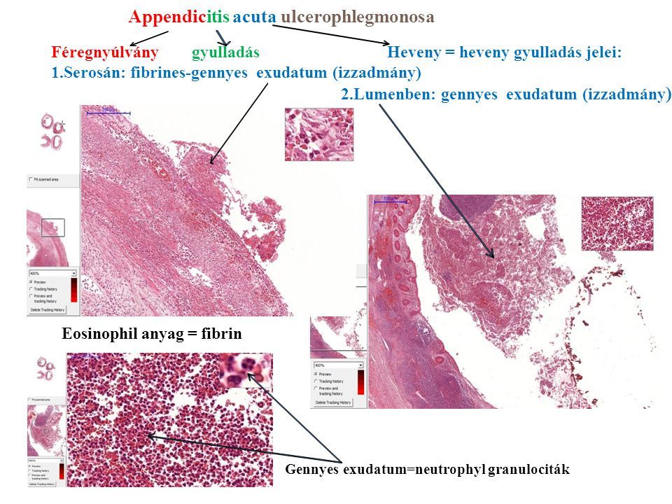 Appendicitis acuta ulcerophlegmonosa Féregnyúlvány gyulladásHeveny = heveny gyulladás jelei: 1.Serosán: fibrines-gennyes exudatum (izzadmány) 2.Lumenben: gennyes exudatum (izzadmány ) Eosinophil anyag = fibrin Gennyes exudatum=neutrophyl granulociták